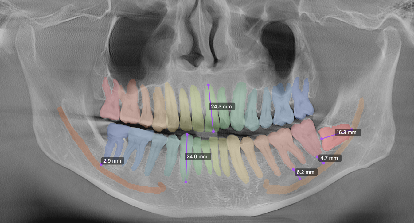 Panoramic X-ray Analysis